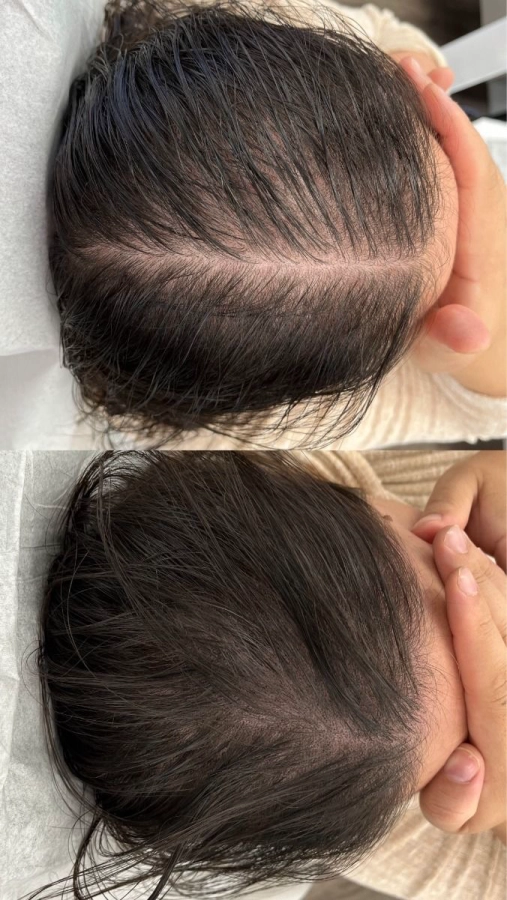 Tricopigmentation H/F par zone (la séance)