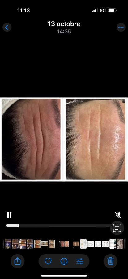 SOIN DU VISAGE CARBON PEEL TOUT TYPES DE PEAUX ET ANTI TACHES