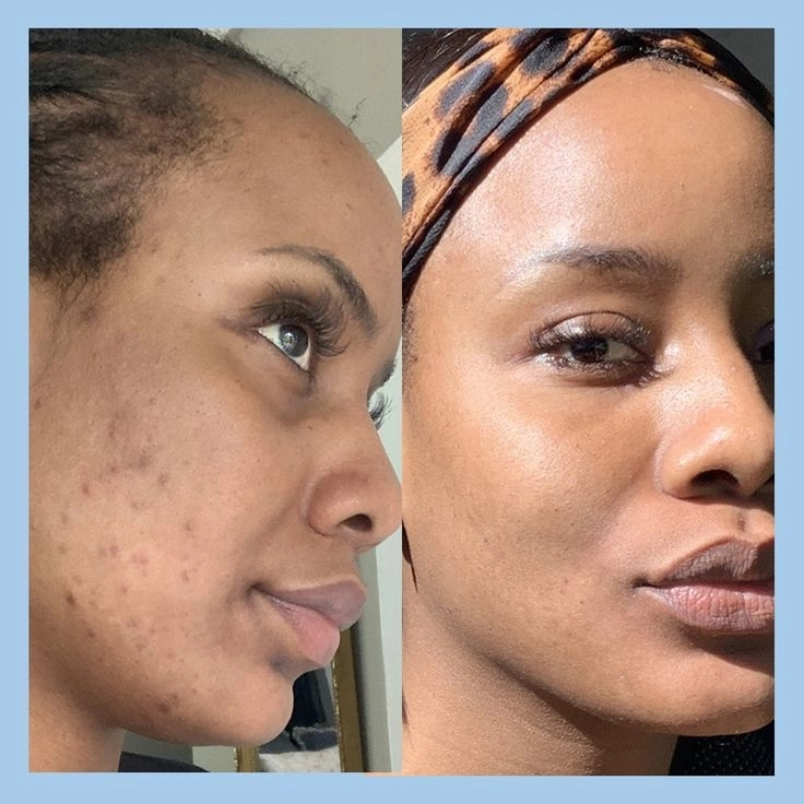 Soin purifiant peaux à  problèmes