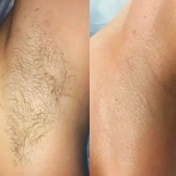 Épilation au laser : Aisselles + Maillot Intégral + Demi-jambes