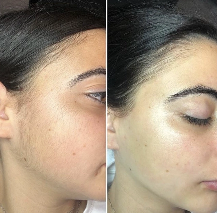 Épilation au fil des joues