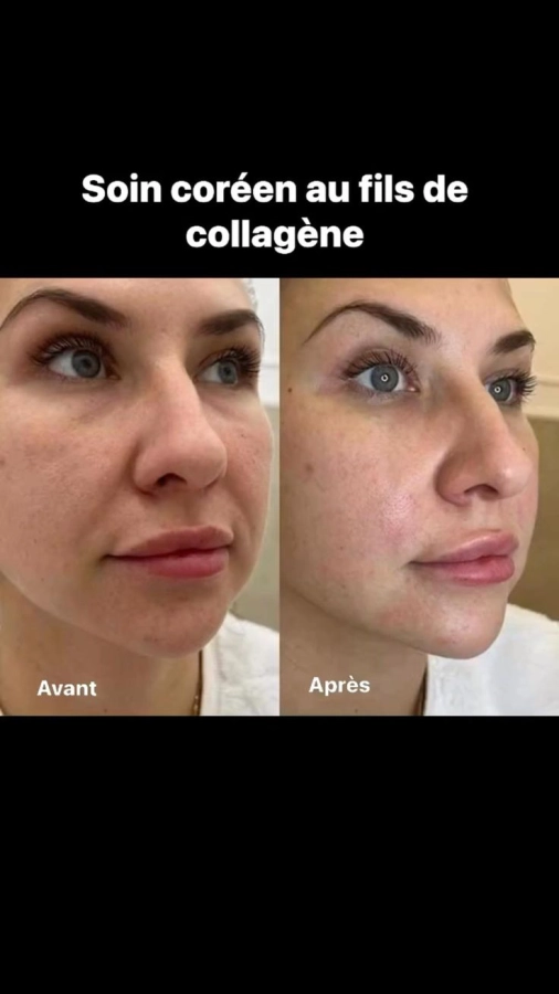 Lifting coreen (application de fils sur visage + soin) application de fils sur visage + soin