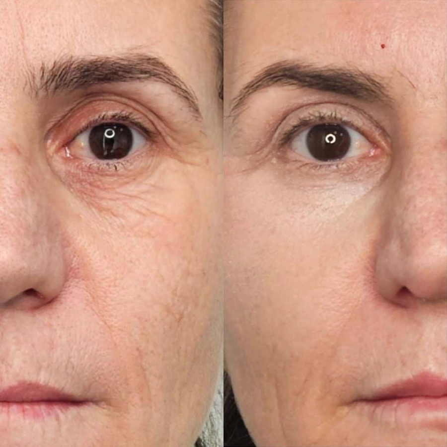 ANTI-ÂGE ET FÉRMETÉ : Soin jeunesse revitalisant "AGE LOGIC" Hydradermie jeunesse 