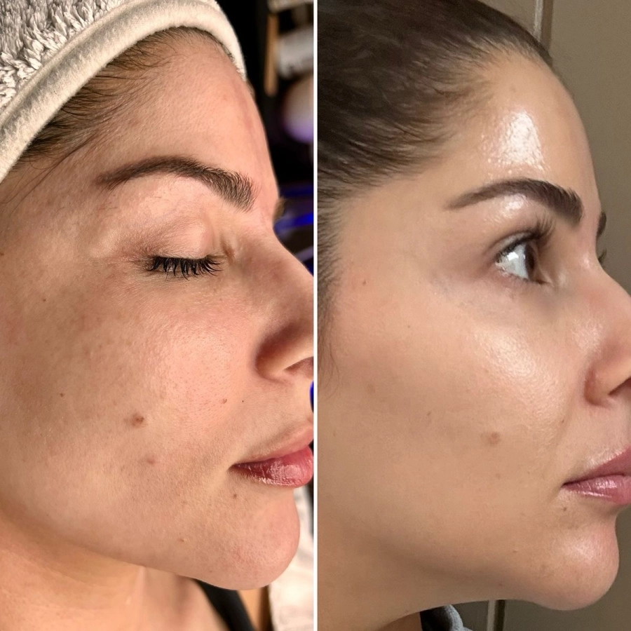 Lifting coréen (application de fils sur visage) application de fils sur visage