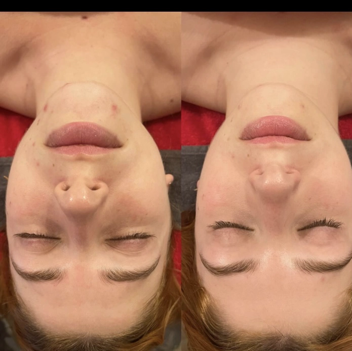 HYDRADERMIE : Soin de beauté personnalisé du visage par type de peau