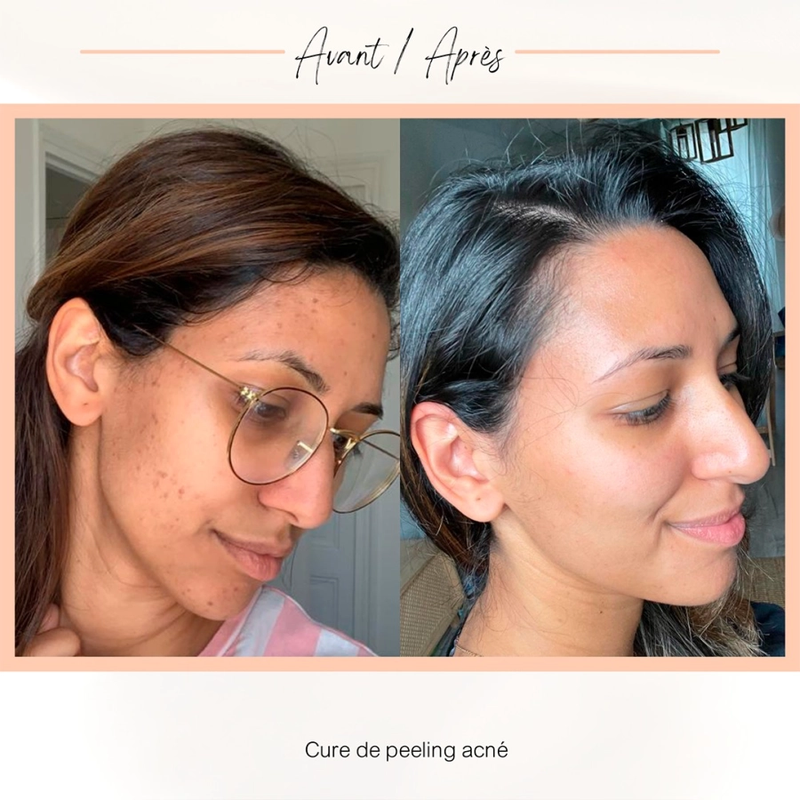 Peeling Anti-Acné ( venir démaquillée)