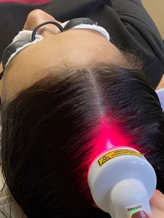Forfait 6 séances Hairneedling Radiofréquence+ LED