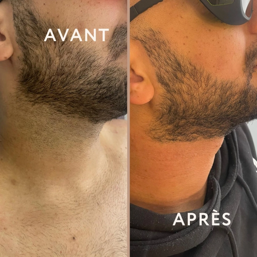 Épilation au laser homme - Barbe 